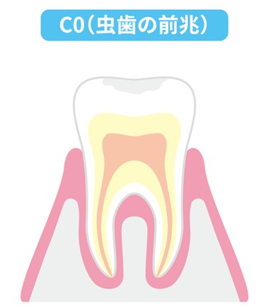 虫歯 C0